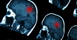 Microwave Ablation Helps Attack Tumors Microwave Ablation Helps Attack Tumors